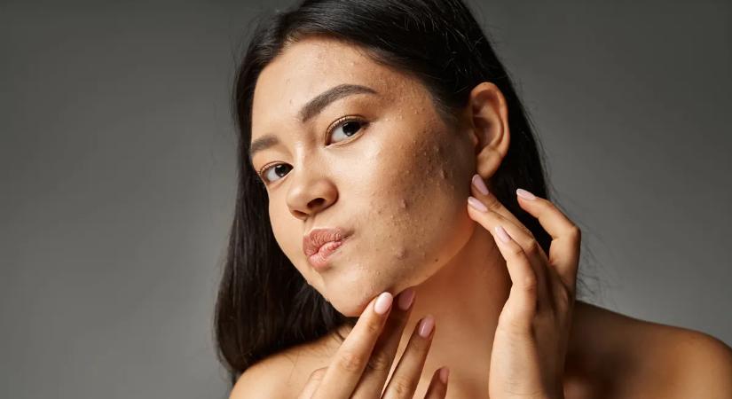 SOS pattanásfedés 40 felett: így lesz hibátlan a bőröd – Tippek és termékek