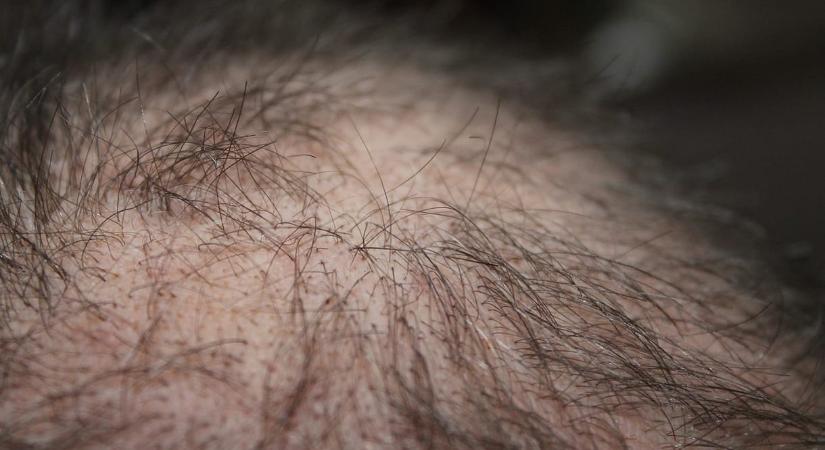 539%-kal pörgeti fel a hajnövekedést az új kopaszodás elleni gyógyszer