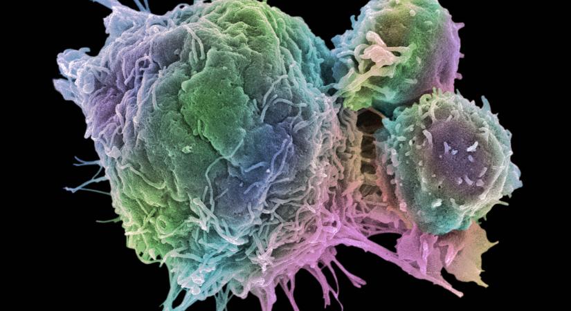 Áttörés lehet a leukémia gyógyításában ez a DNS-módosításra épülő, új terápia