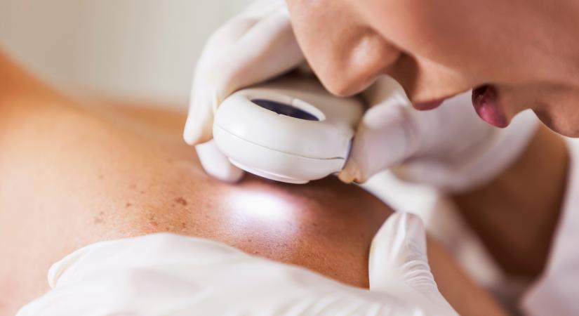 Angioszarkóma: a ritka rákfajta 6 tünete