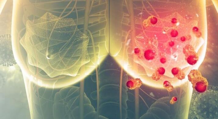 Siker a mellrák legyőzésében – Új, ígéretes kisérleti gyógyszer, a giredestrant