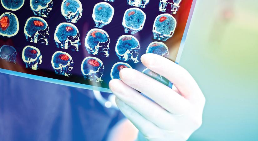 Hasznos vagy kockázatos mindennap aszpirint szedni? Mit tanácsolnak az orvosok?