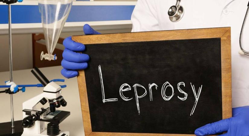 Leprás megbetegedést igazoltak Kolozsváron egy ázsiai nőnél