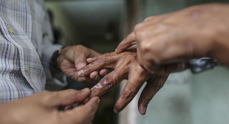 Több mint negyven év után újra leprás megbetegedést igazoltak Kolozsváron