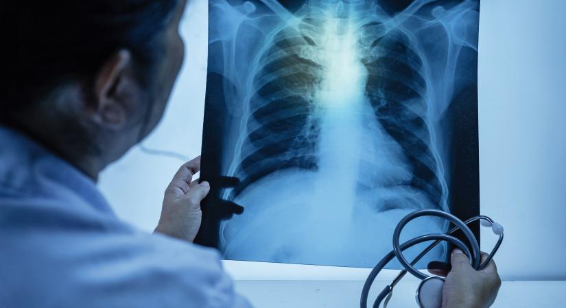 Mitől lehet tüdőrákos, aki soha nem dohányzott?