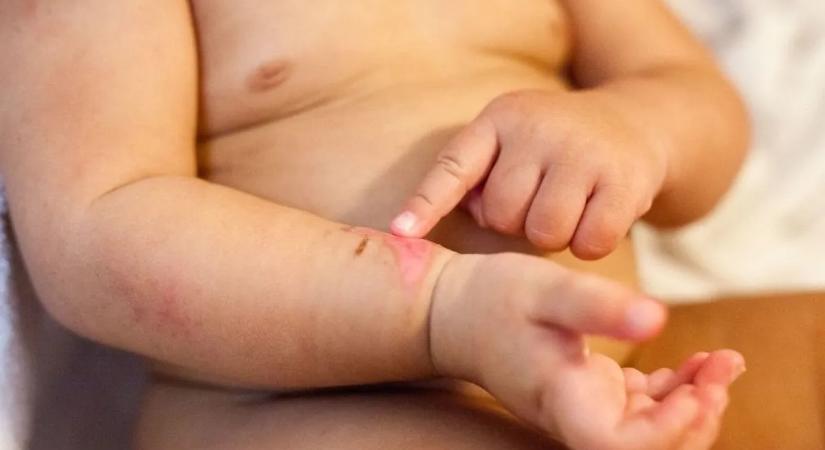 Sok szülőt váratlanul ér: karácsonykor a leggyakoribb az égési sérülés