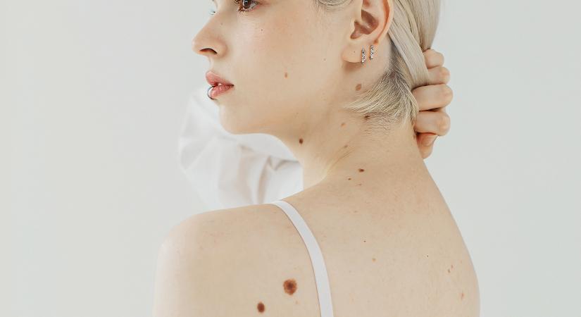 Anyajegy kényes, intim helyeken