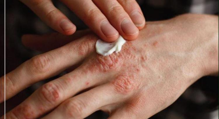 Leprás megbetegedéseket regisztráltak szomszédainknál