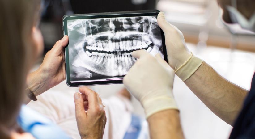 A fogászati implantátum kétélű fegyver. Miért ennyire népszerű mégis?