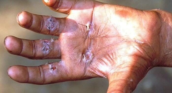 Negyven év után először regisztráltak veszélyes betegséget egy Ukrajna szomszédjában