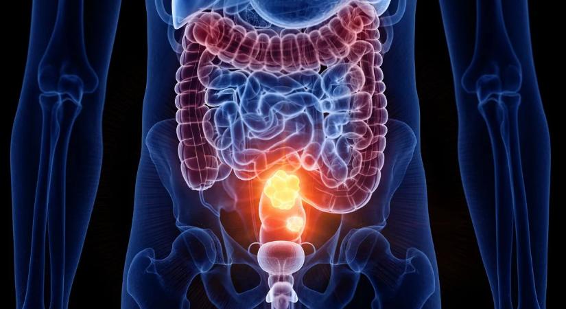 Vastagbélrák: a csendes gyilkos, amit egy egyszerű vizsgálattal megelőzhetsz