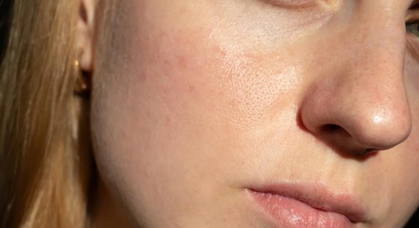 Mit üzen a bőröd? 6 jel, hogy vitaminhiányod van