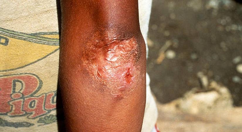 Újabb szomszédunkban bukkant fel a félelmetes középkori betegség, kérdés, átlépi-e a határt