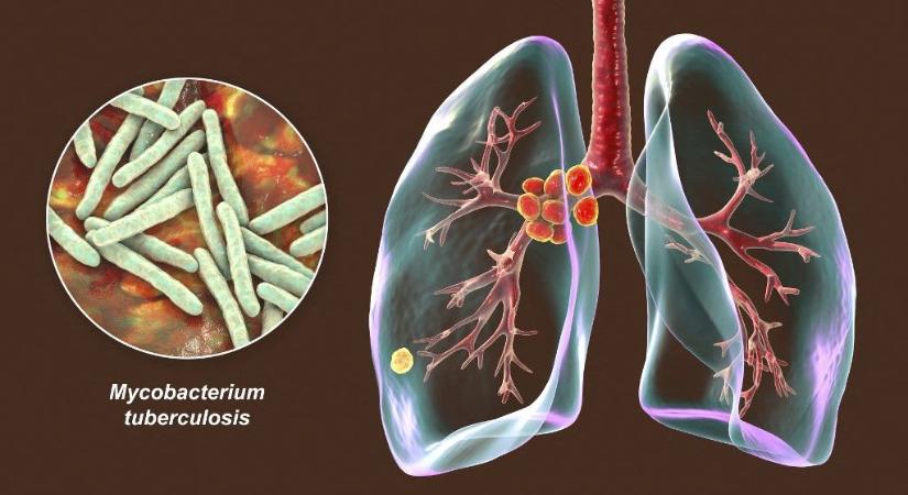 Novemberben Ukrajnában több mint 1100 tuberkulózisos esetet regisztráltak