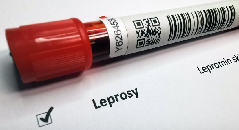 Mekkora veszély kolozsvári lepra? A szakértő válaszol