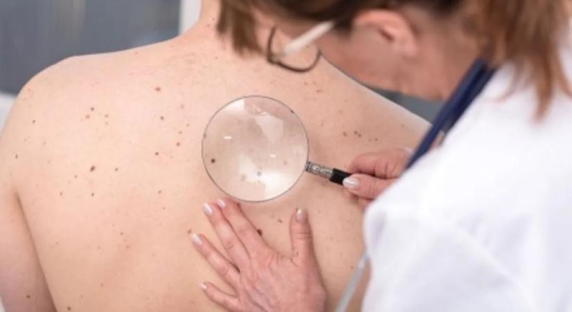 Hány anyajegyet lehet eltávolítani egyszerre?