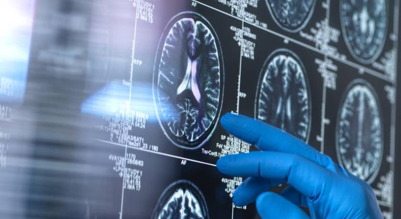 Demens embereknek adtak egy elterjedt gyógyszert – gyorsította a betegség előrehaladását