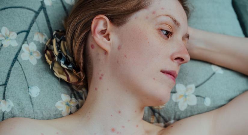 Nem csak gyerekbetegség: mit tegyünk, ha felnőttként kapjuk el?