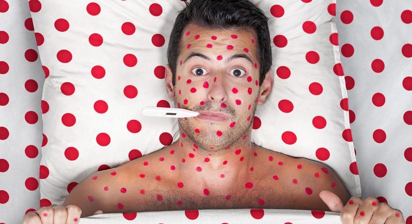 Nem csak piros pöttyök: felnőttként súlyos szövődményeket okozhat egy ártalmatlan gyerekbetegség