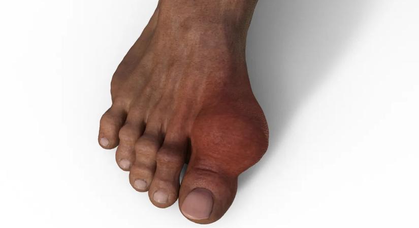 Megdöbbentő fordulat: az „idősek betegsége” egyre több 40 év alatti fiatalt támad meg