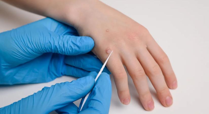 Így szabadulhatsz meg tartósan a szemölcsöktől