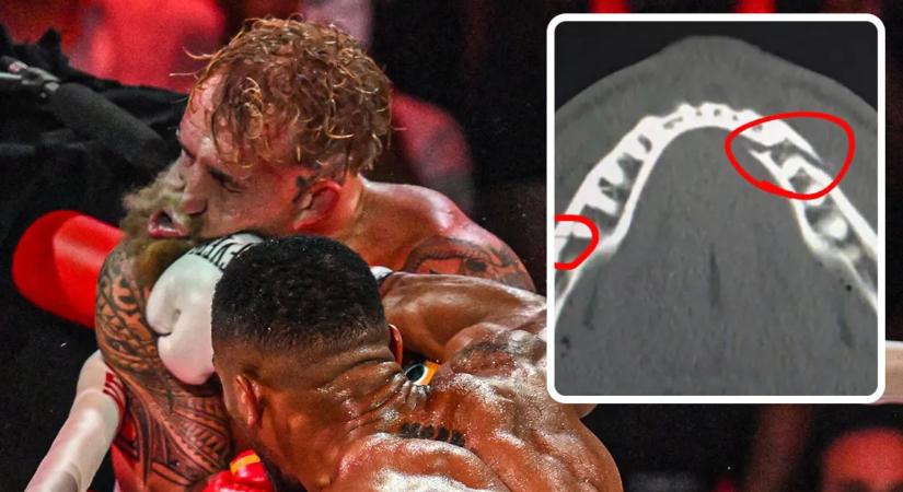 Így törte el a korábbi youtuber állkapcsát Joshua – kép