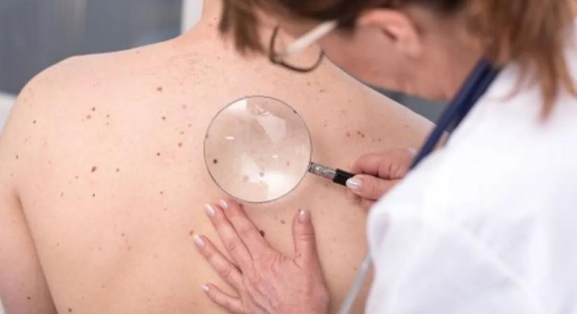 Hány anyajegyet lehet eltávolítani egyszerre?