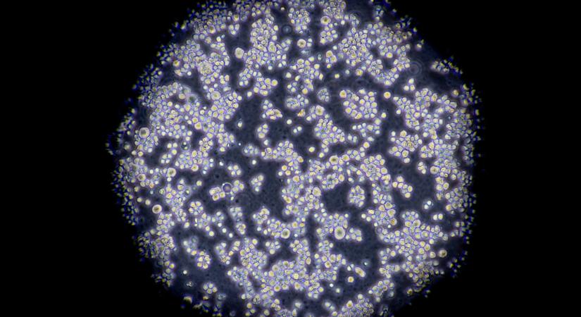 A vizeletminta AI-vizsgálatából kiderülhet, hogy milyen betegségek alakulhatnak ki egy embernél