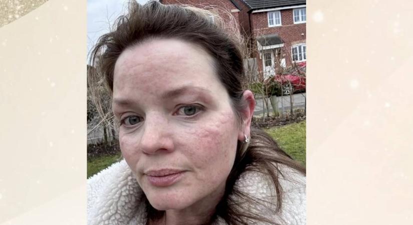 A nő, aki allergiás a télre – ezekkel a fájdalmas tünetekkel kell együtt élnie