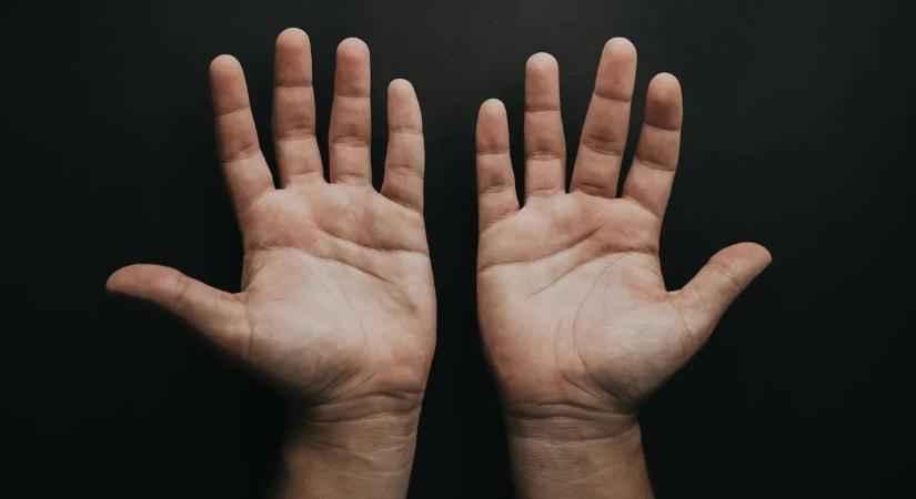 Hihetetlen: egy férfi keze önálló életre kelt egy ritka betegség következtében