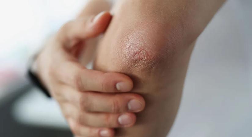 A sötét és érdes könyökért nem a kosz a felelős – ez állhat a háttérben