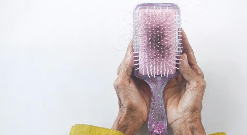 „Nem érzem magam önmagamnak” – nők ezreit teszi tönkre a hajhullás