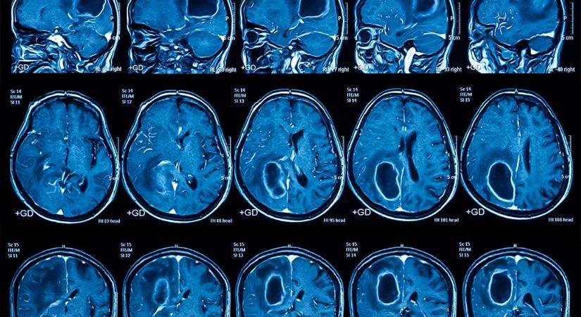 Agydaganat ellen orrcsepp?