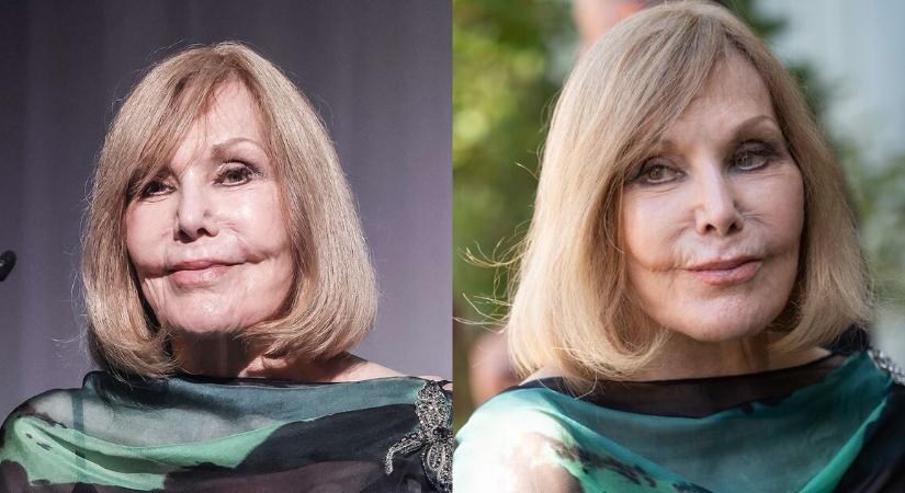 Döbbenetes átalakulás: a plasztikai műtétek után alig lehet ráismerni az egykori szépségre