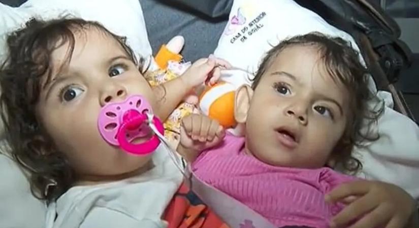 Tragikus véget ért az ikerlányok családja: hónapokkal az életmentő szétválasztó műtét után meghalt a sziámi ikerpár másik tagja is