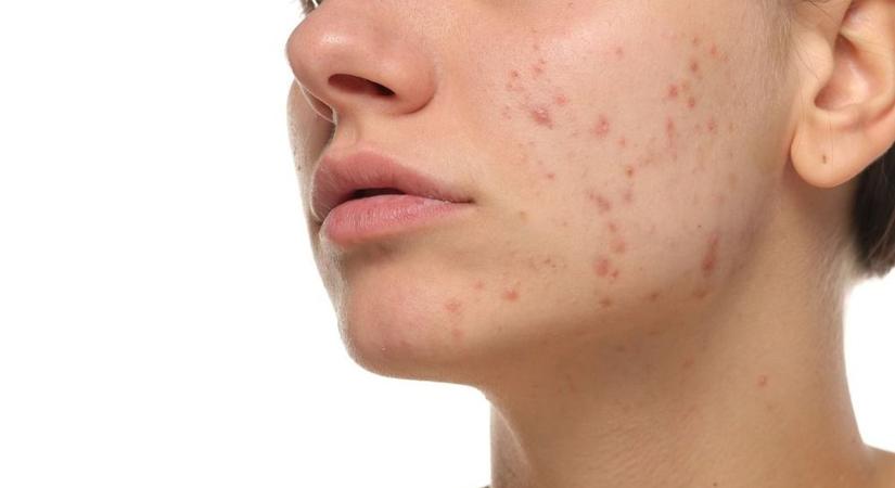 Az A-vitamin hiány jelei, amiket nem szabad figyelmen kívül hagyni