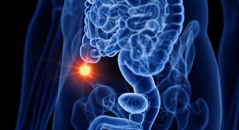 Kiadták a figyelmeztetést: megugrott egy ritka rákfajta előfordulása a fiatalok körében