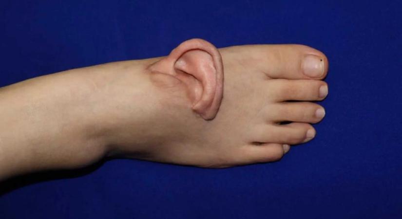 Lábfejére varrták fel a leszakadt fülét egy nőnek Kínában