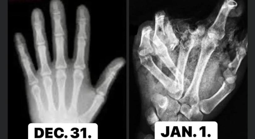 Leszakadt ujjak, szétroncsolódott kezek – erre figyelj, hogy ne legyen rémálom a szilveszteri buli