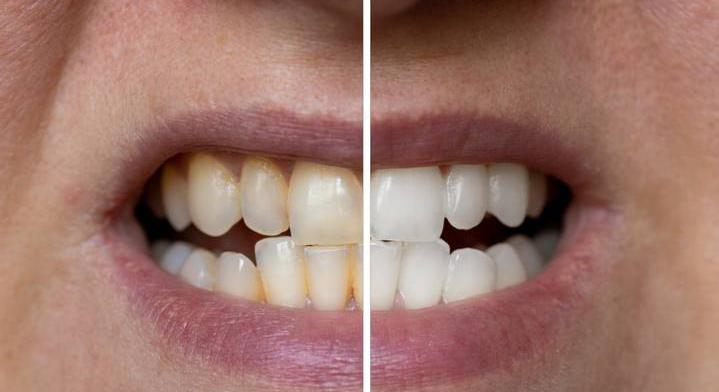 Súlyos betegségeket is jelezhet fogaid elszíneződése