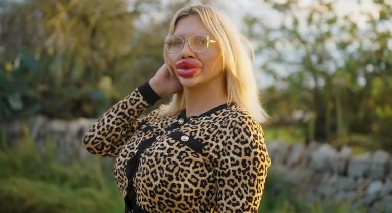 Egy nő olyan sokat plasztikáztatott, hogy már több benne a műanyag, mint a testzsír