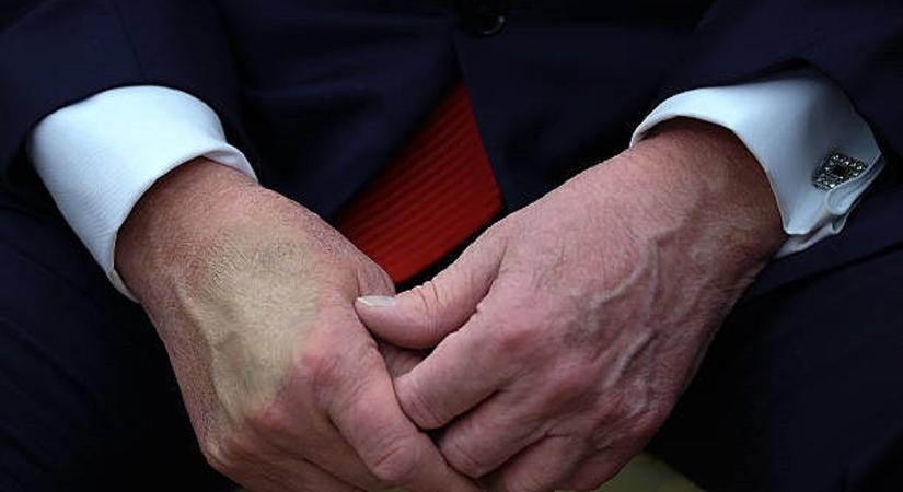 Donald Trump megszólalt az egészségi állapotáról: ezért kék-zöld a keze folyton