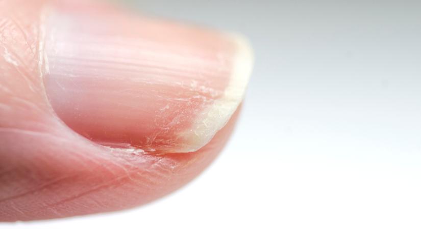 5 dolog ami károsítja a körmeidet, anélkül, hogy észrevennéd