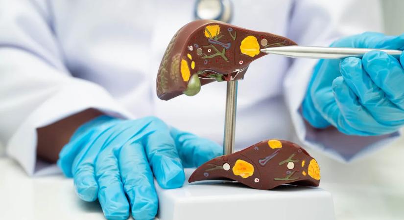 Tényleg az alkohol a hibás? Téged is utolér a zsírmáj?