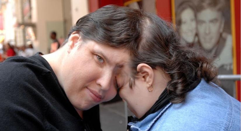 Egy testben két élet: összenőtt ikrek, akik mindent megéltek, amit csak ember megélhet