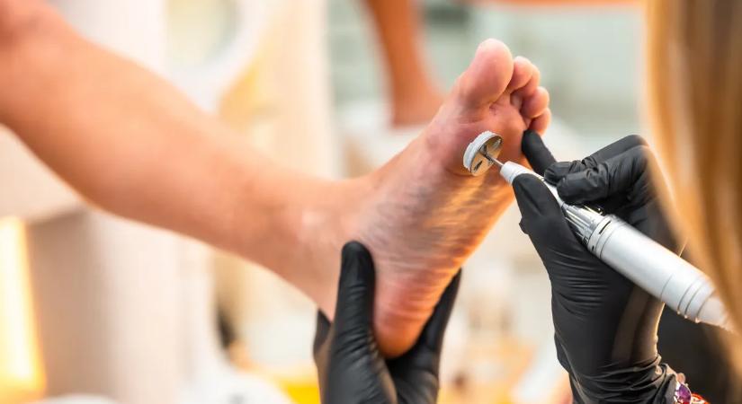 Alig találsz jó cipőt? Így szabadulhatsz meg tartósan a tyúkszemtől