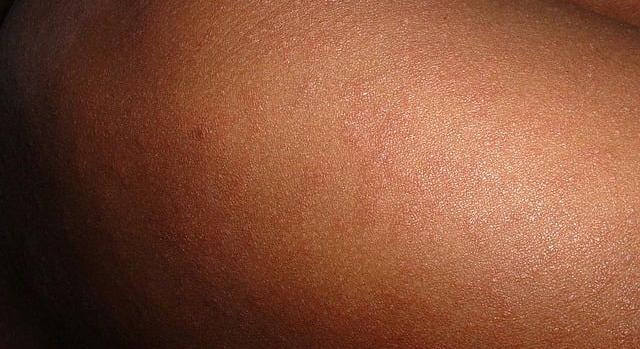 Visszatért a rettegett járvány: elszabadult a kanyaró Amerikában, több mint 2000 esetet jelentettek egy év alatt