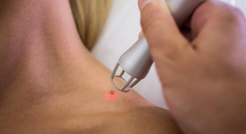 Hogyan szabadulhatunk meg a szemölcstől?