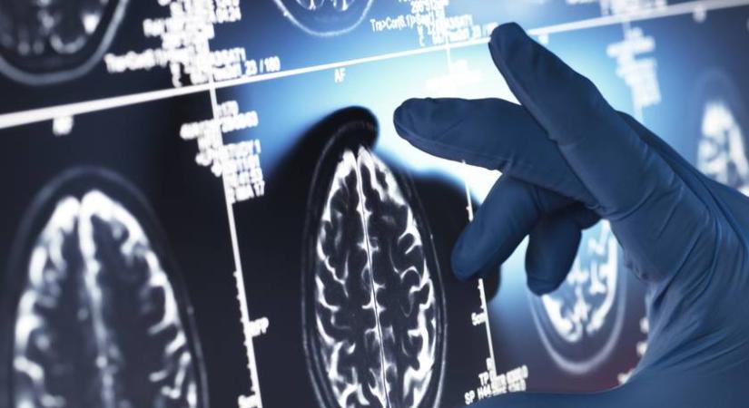 A tudósok rájöttek, mi lehet az Alzheimer-kór okozója: több gén működéséért is felel