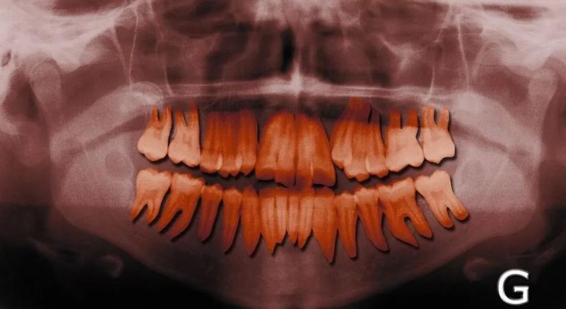 Itt a meglepő válasz: miért nem számítanak a fogak csontnak